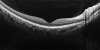 OCT（眼底三次元解析装置）